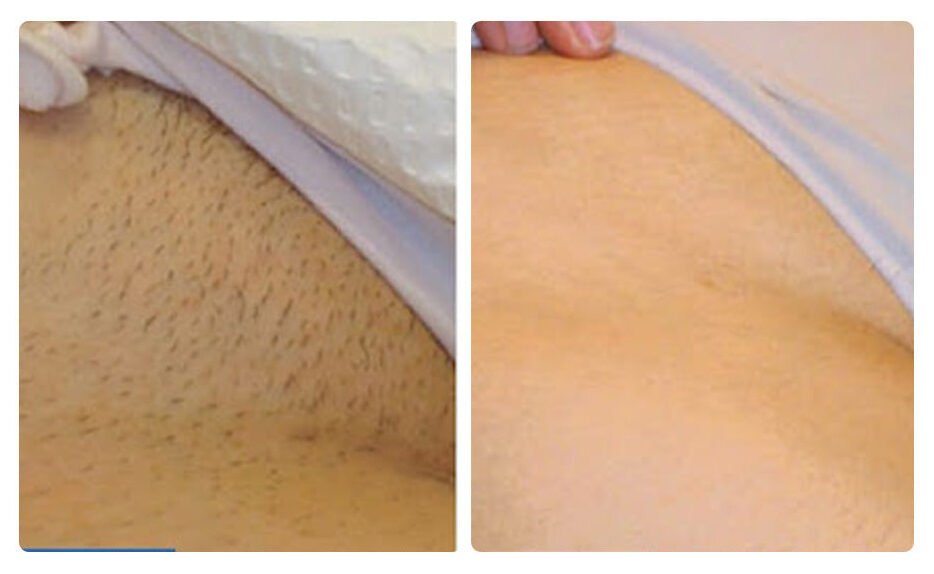 ГЕЛЬ-КРЕМ ДЛЯ ВИДАЛЕННЯ ВОЛОССЯ